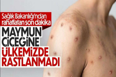 Sağlık Bakanlığı'ndan maymun çiçeği vakası açıklaması! 'Ülkemizde görülmemiştir'