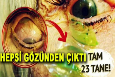 Gözünde unuttuğu kontakt lensler dehşeti yaşattı! 23 tane çıkınca doktor bile inanamadı